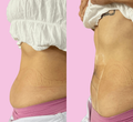 Curvee Tummy → בטן